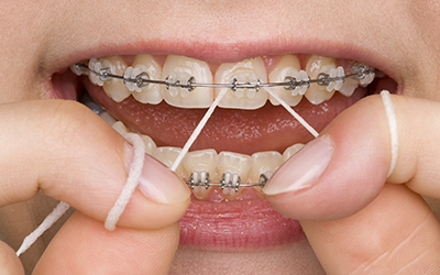 Close-up of oral hygiene on braces
