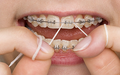 Close up of braces and flossing