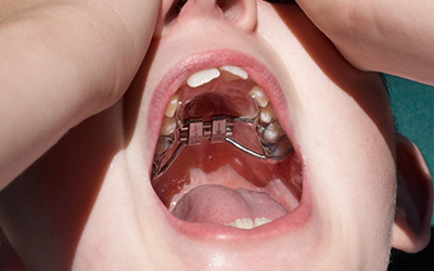 Childs mouth open with braces